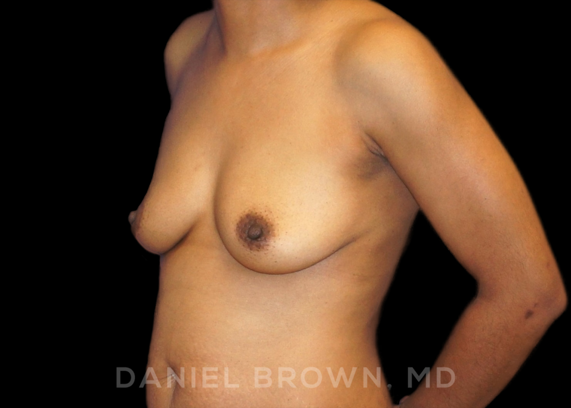 Breast Augmentation Patient Photo - Case 2349 - before view-