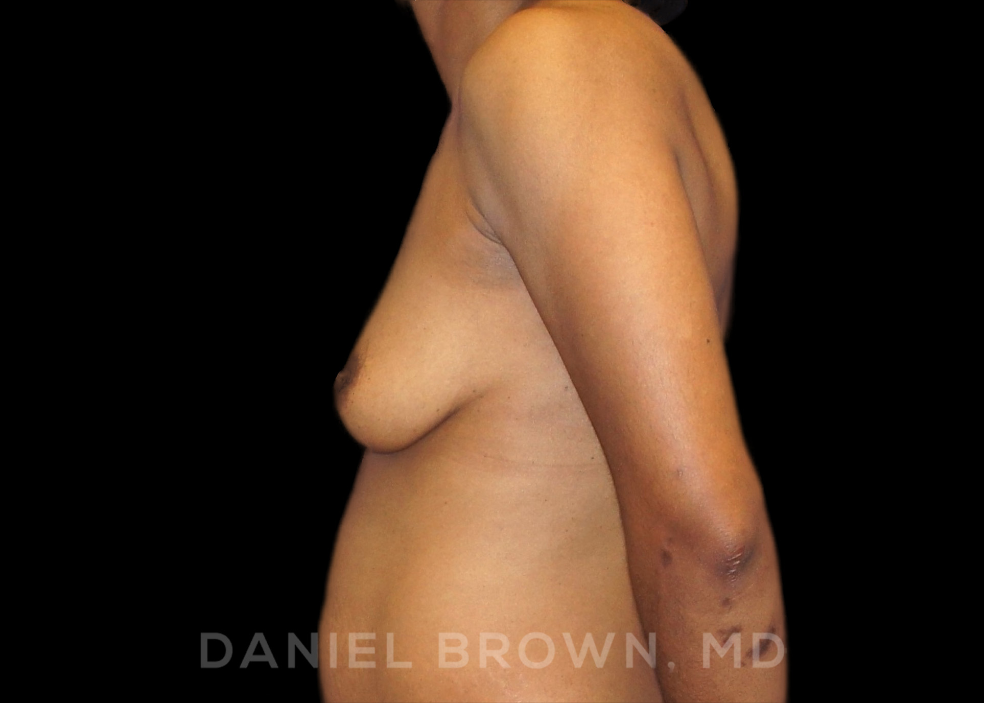 Breast Augmentation Patient Photo - Case 2349 - before view-2