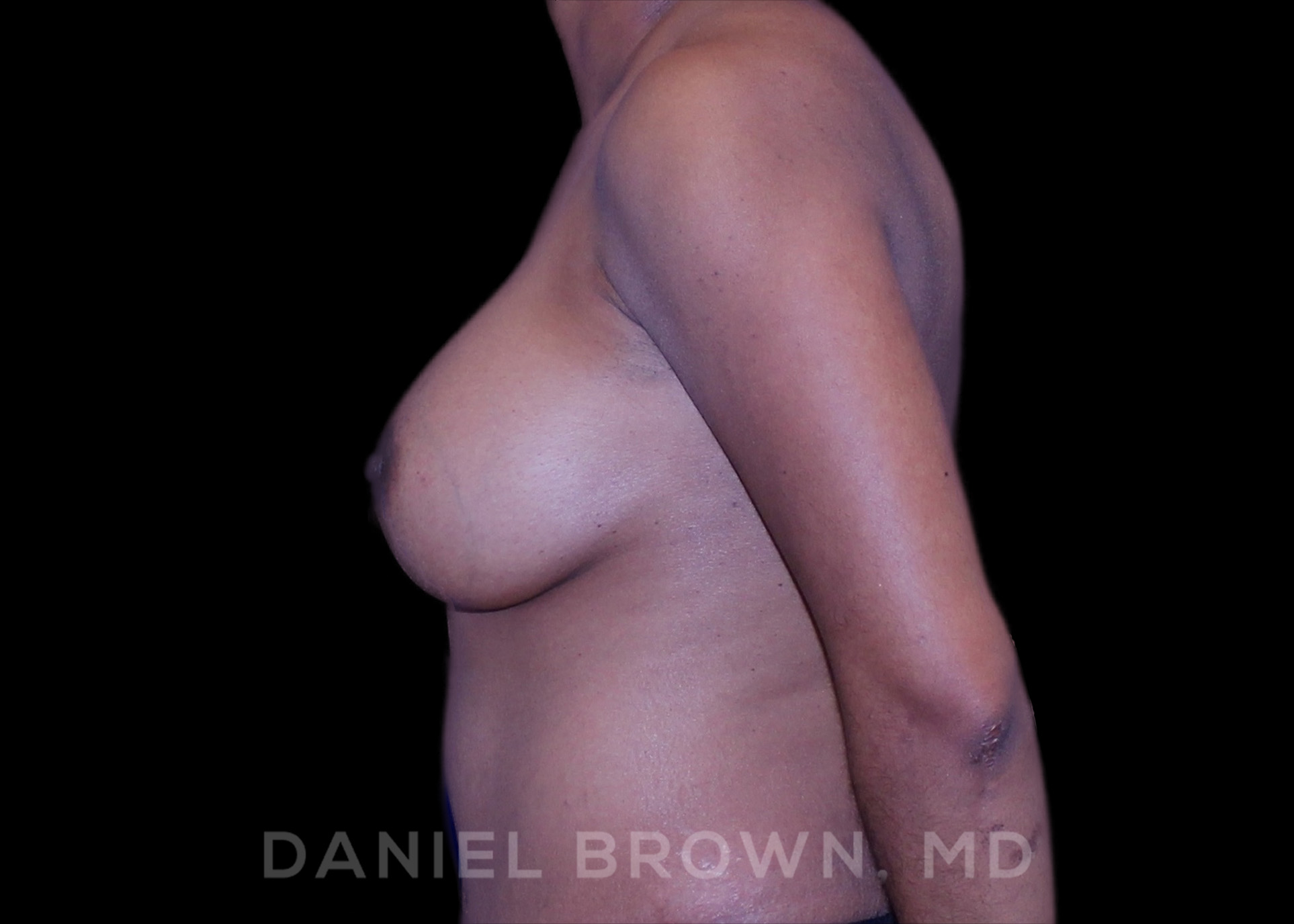 Breast Augmentation Patient Photo - Case 2349 - after view-2