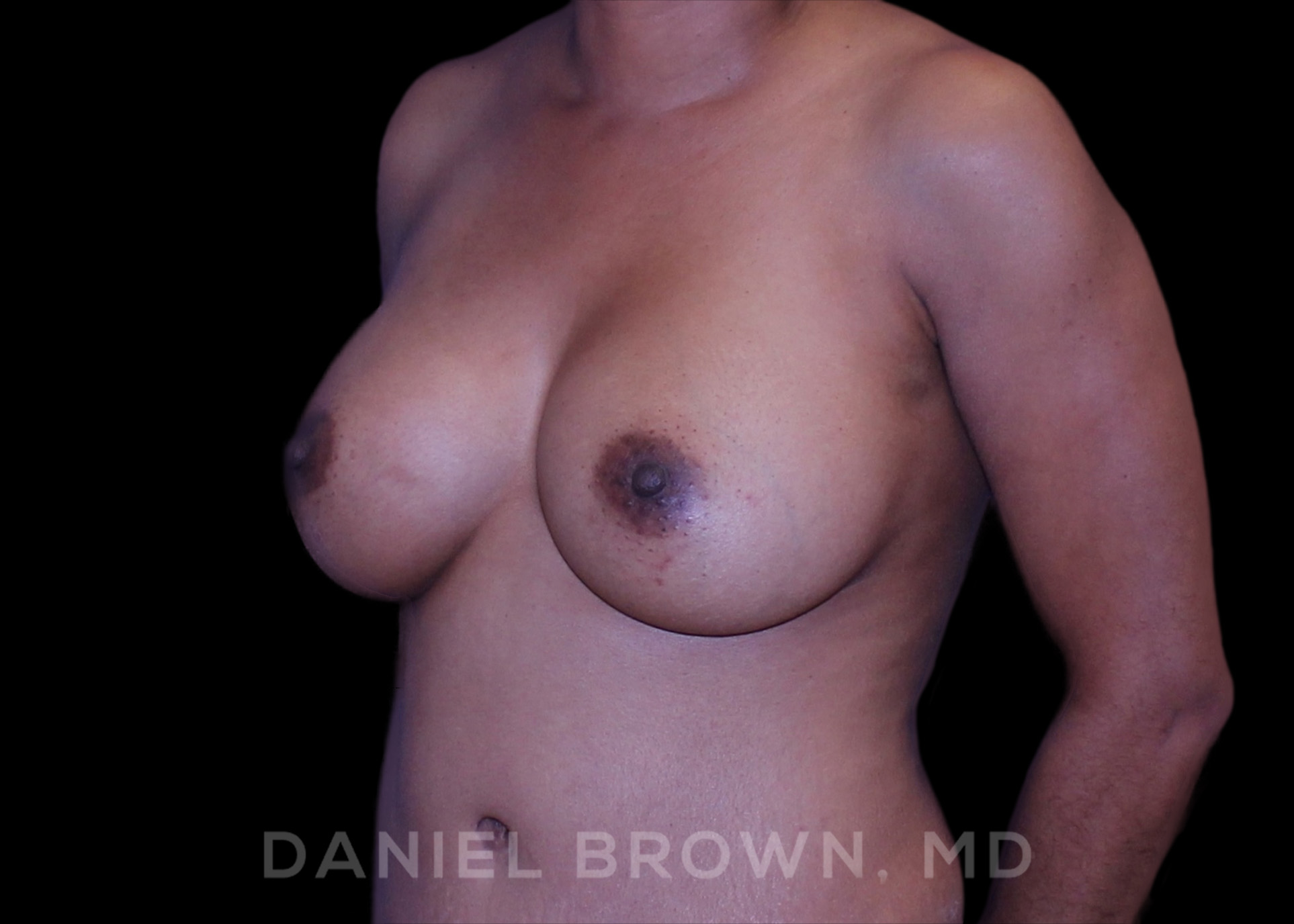 Breast Augmentation Patient Photo - Case 2349 - after view