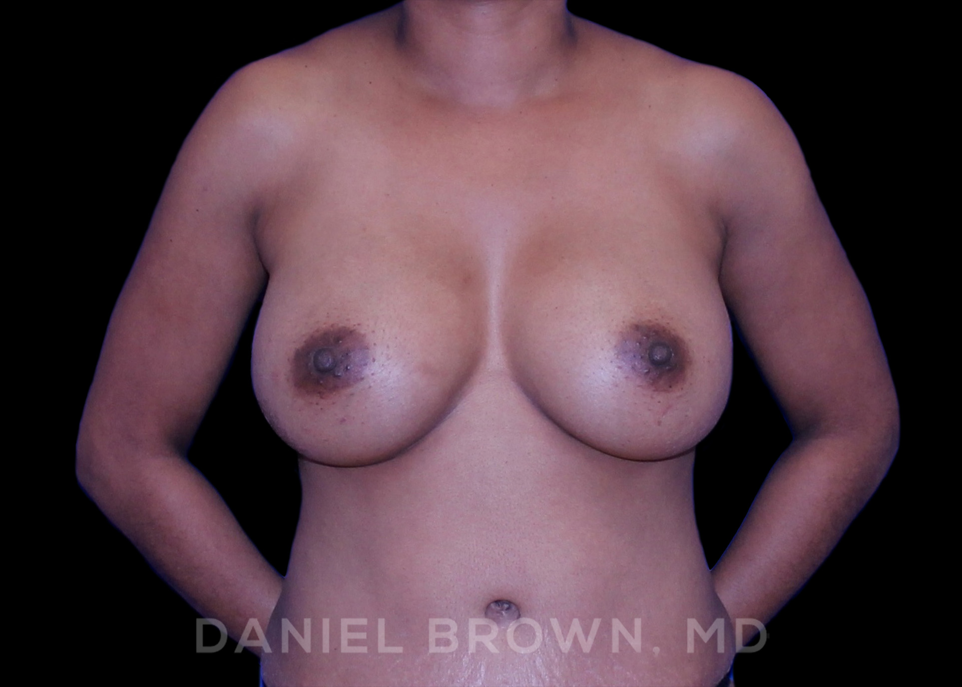Breast Augmentation Patient Photo - Case 2349 - after view-0
