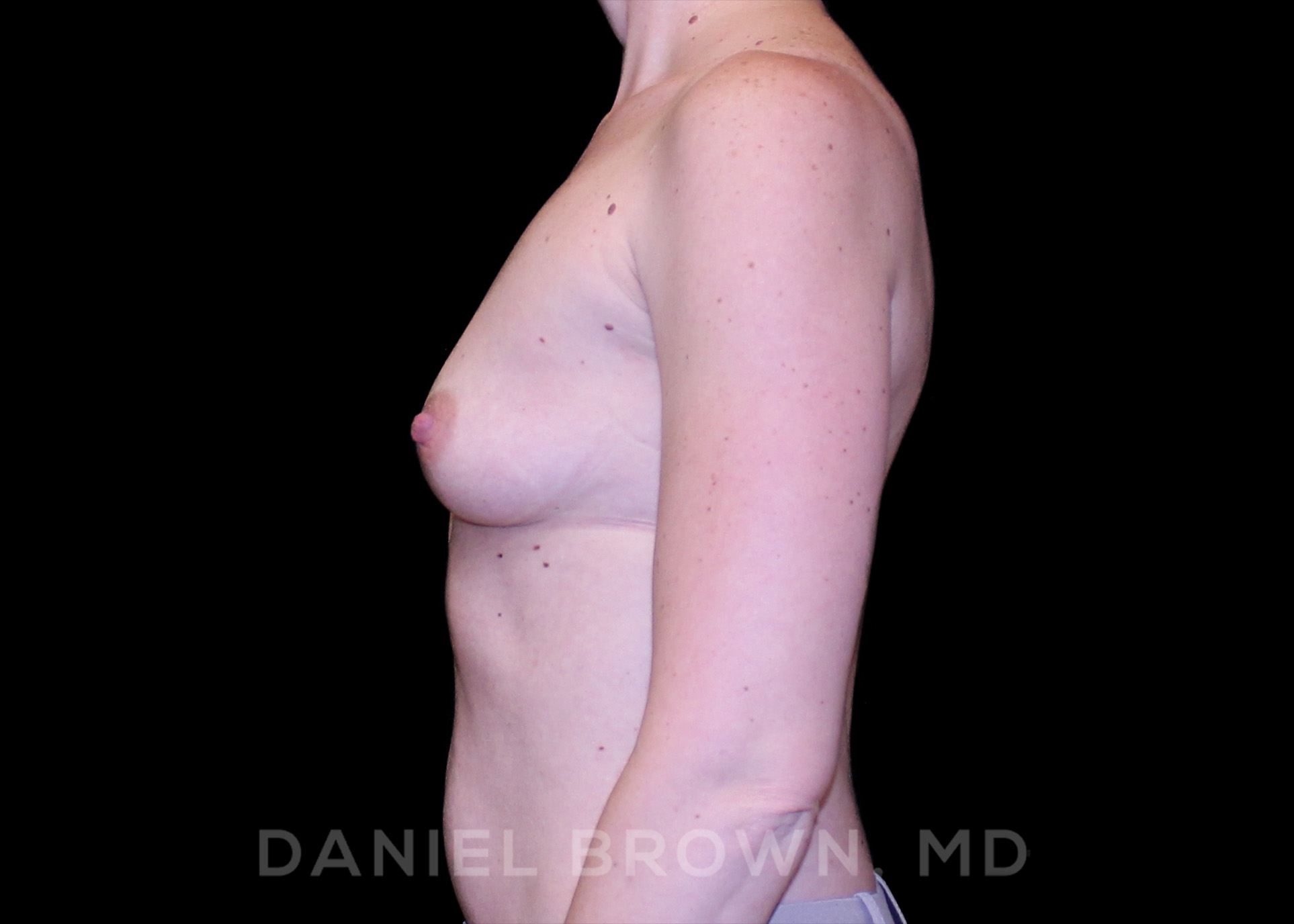 Breast Augmentation Patient Photo - Case 2356 - before view-3