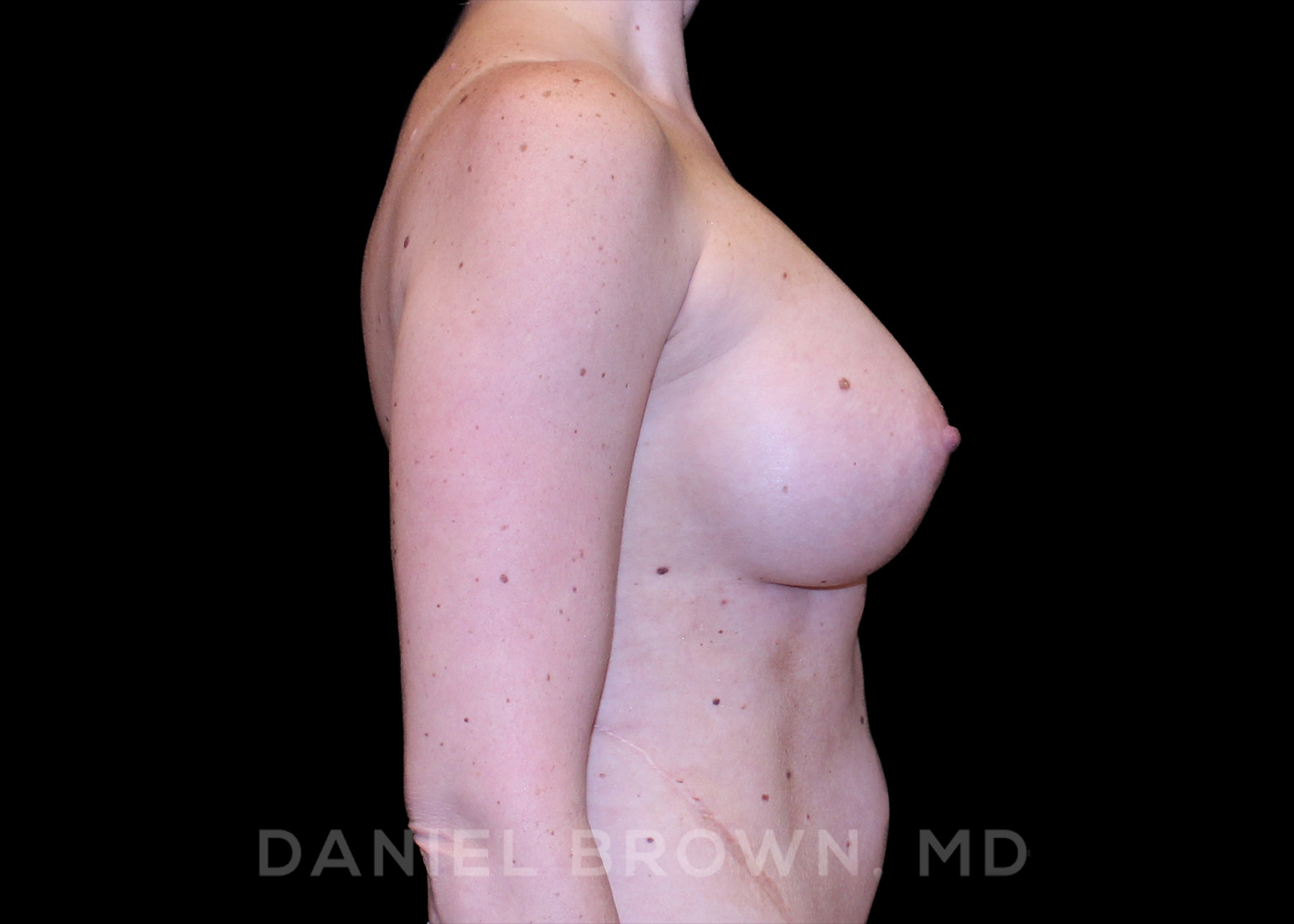 Breast Augmentation Patient Photo - Case 2356 - after view-4