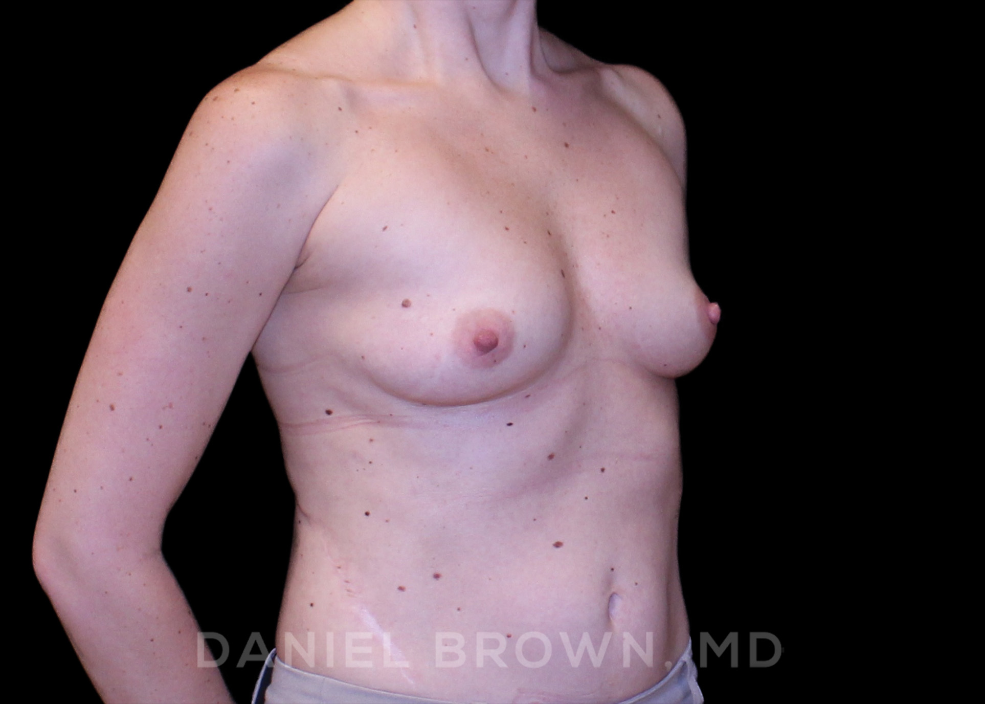 Breast Augmentation Patient Photo - Case 2356 - before view-