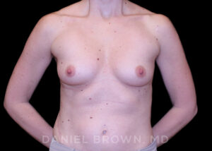 Breast Augmentation - Case 2356 - Before