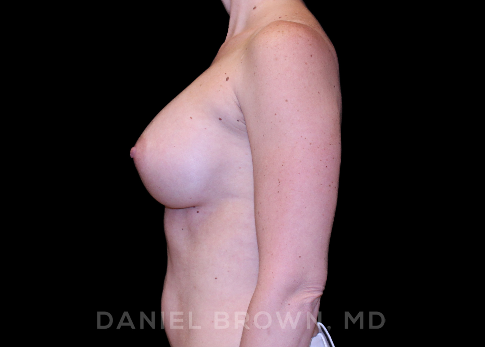 Breast Augmentation Patient Photo - Case 2356 - after view