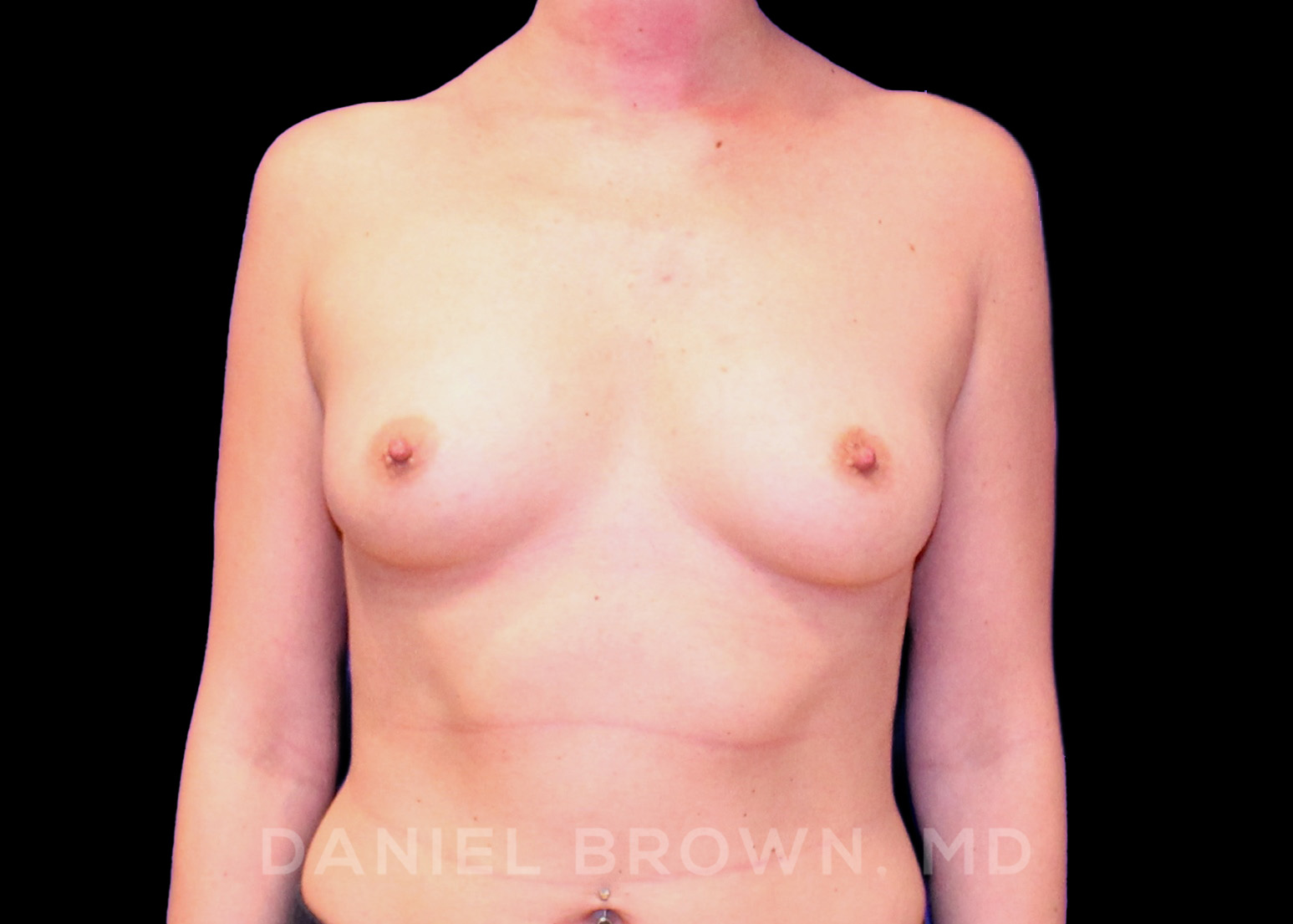 Breast Augmentation Patient Photo - Case 2367 - before view-0