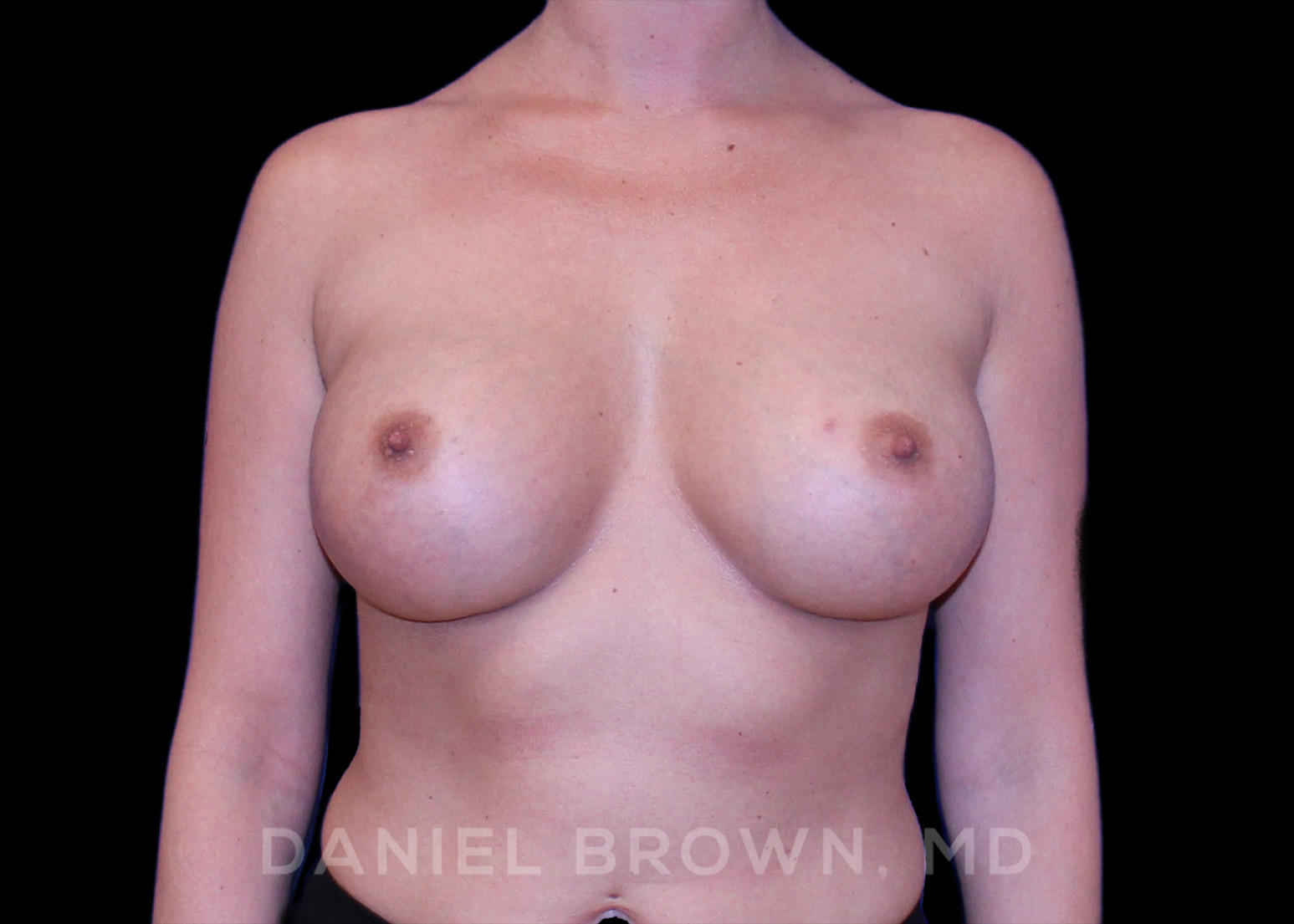 Breast Augmentation Patient Photo - Case 2367 - after view-0