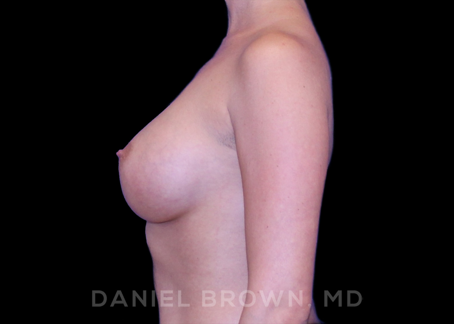 Breast Augmentation Patient Photo - Case 2367 - after view-2