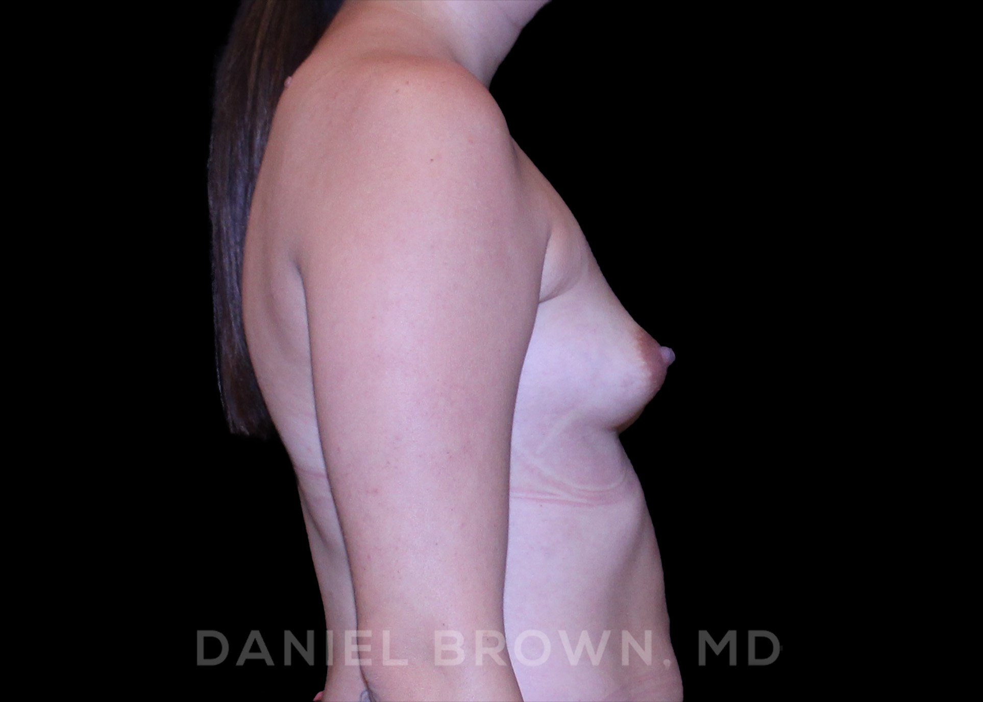 Breast Augmentation Patient Photo - Case 2374 - before view-4