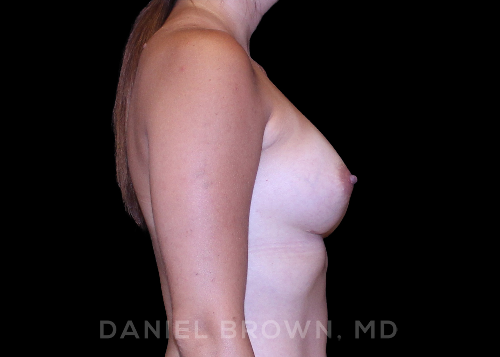 Breast Augmentation Patient Photo - Case 2374 - after view-4
