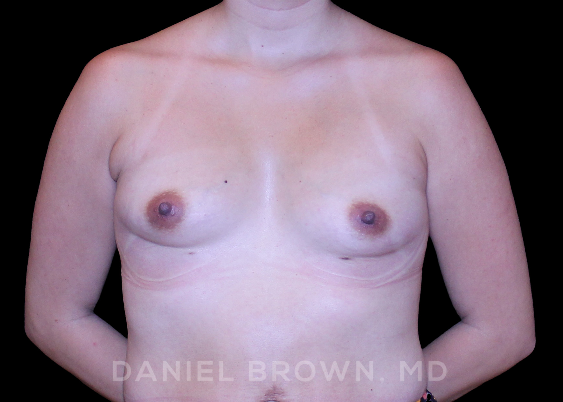 Breast Augmentation Patient Photo - Case 2374 - before view-0
