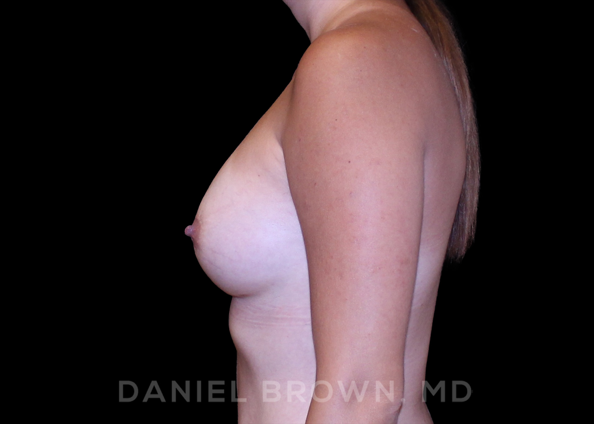 Breast Augmentation Patient Photo - Case 2374 - after view-3