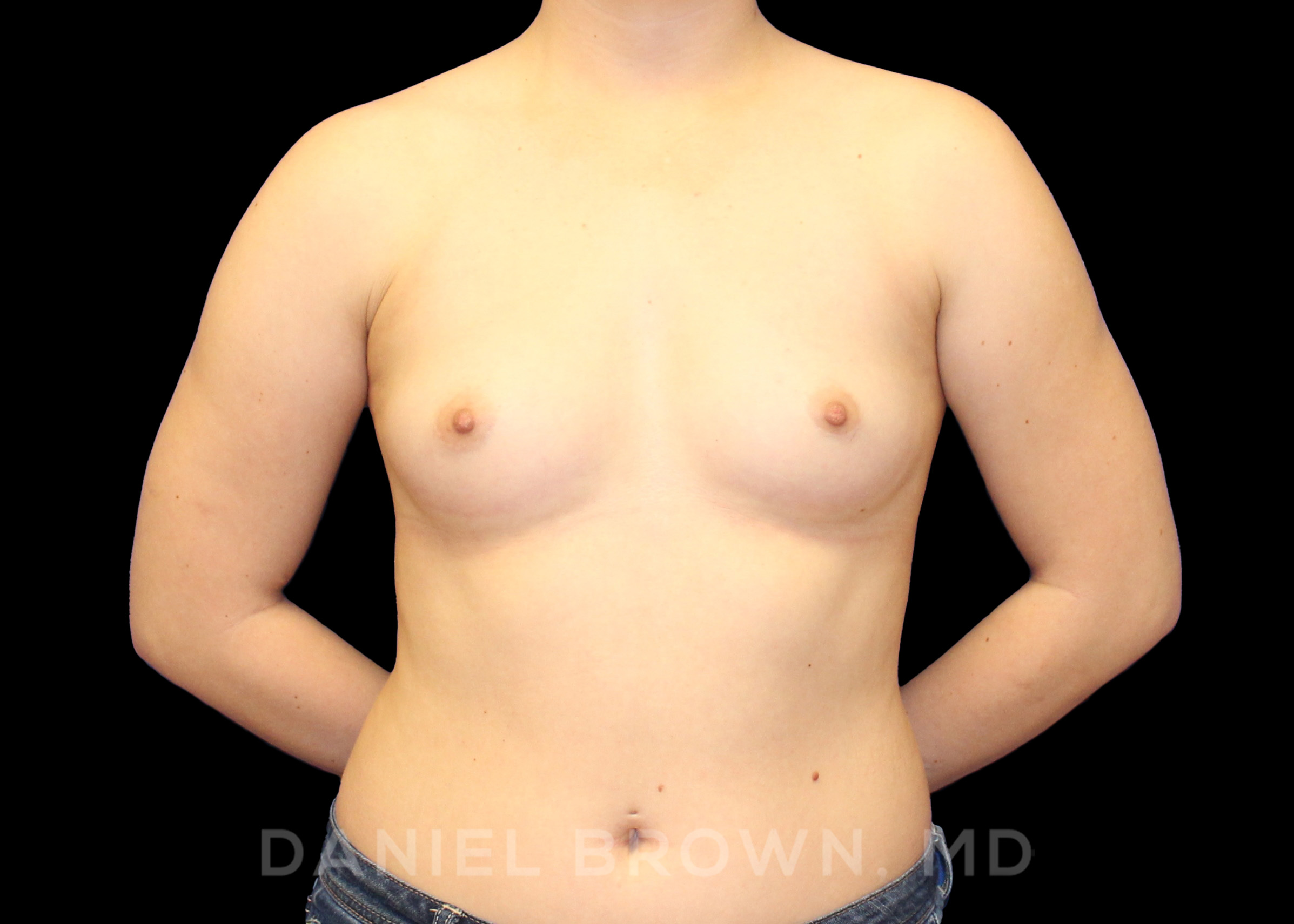 Breast Augmentation Patient Photo - Case 2385 - before view-0
