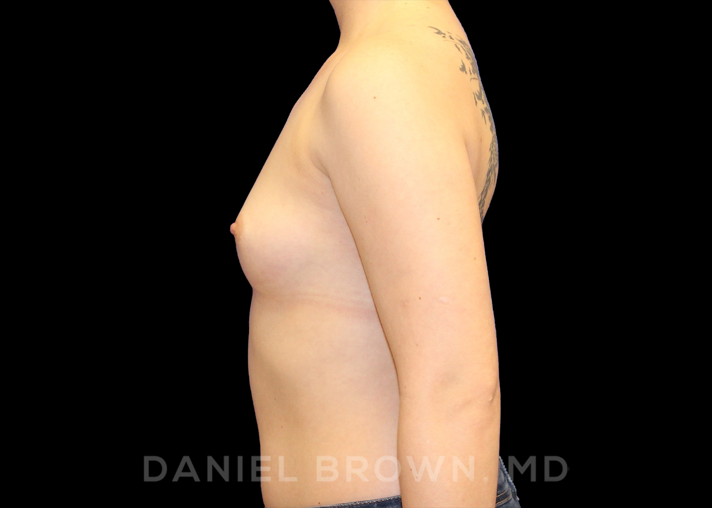 Breast Augmentation Patient Photo - Case 2385 - before view-