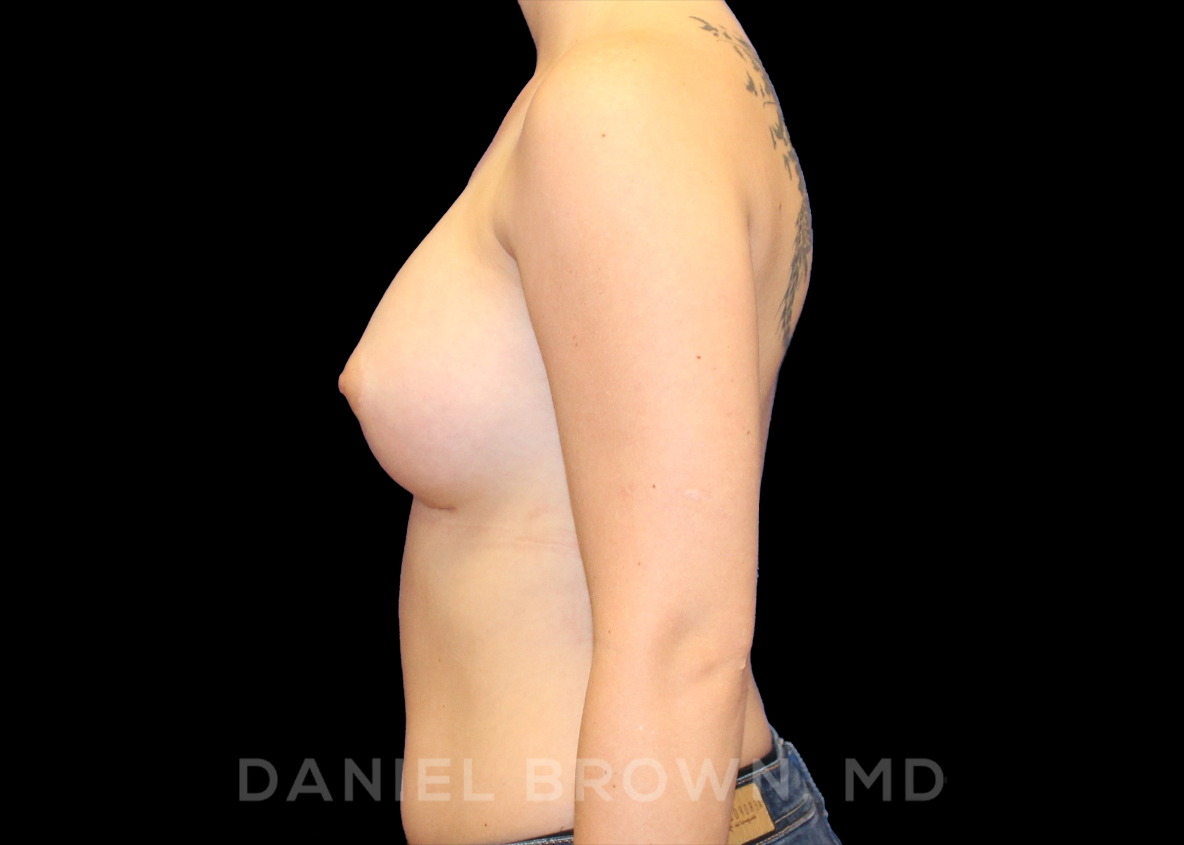 Breast Augmentation Patient Photo - Case 2385 - after view-2