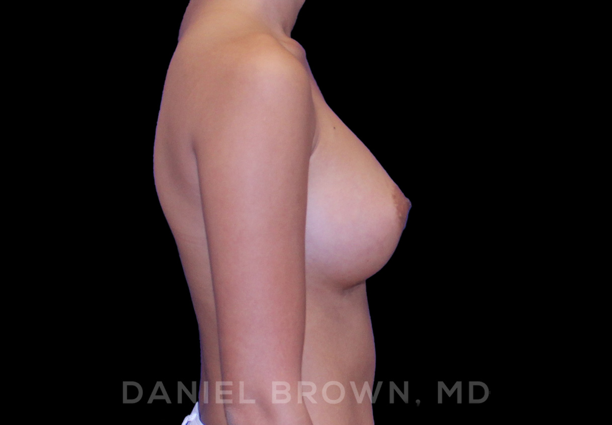 Breast Augmentation Patient Photo - Case 2392 - after view-4