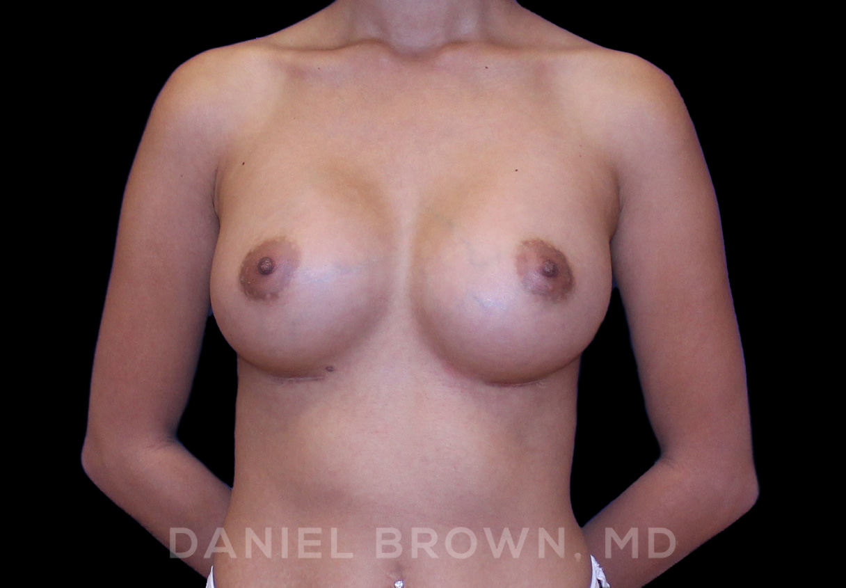 Breast Augmentation Patient Photo - Case 2392 - after view-0