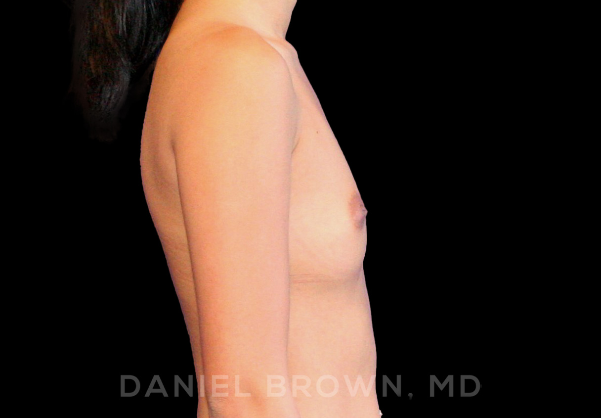 Breast Augmentation Patient Photo - Case 2392 - before view-