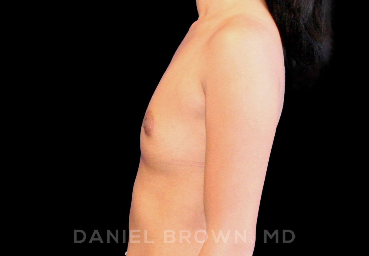 Breast Augmentation Patient Photo - Case 2392 - before view-