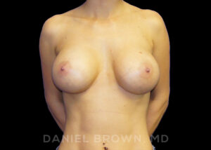 Breast Augmentation - Case 2403 - After