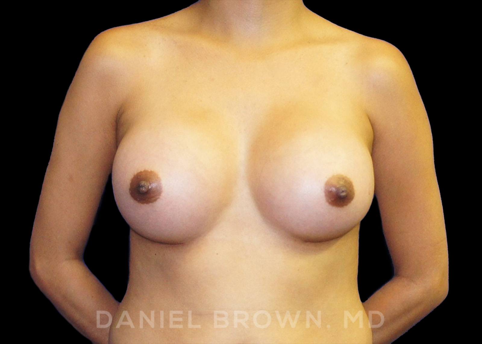 Breast Augmentation Patient Photo - Case 2410 - after view