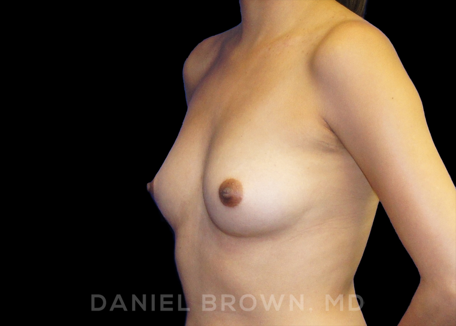 Breast Augmentation Patient Photo - Case 2410 - before view-