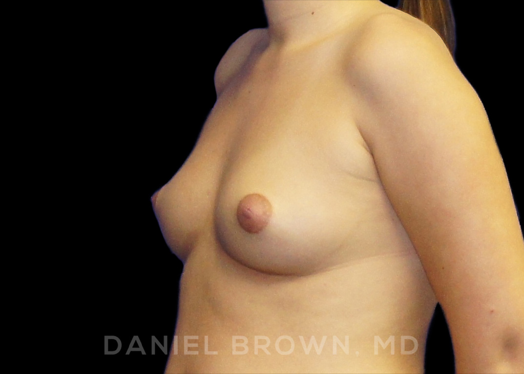 Breast Augmentation Patient Photo - Case 2417 - before view-