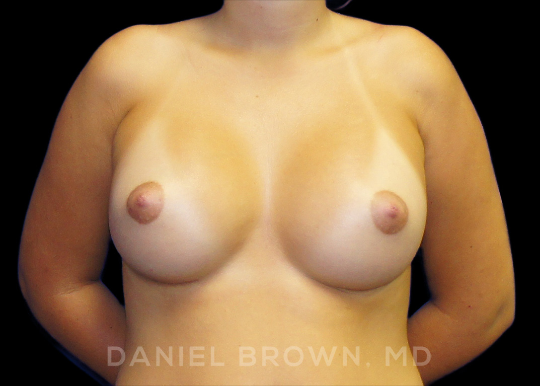 Breast Augmentation Patient Photo - Case 2417 - after view-0