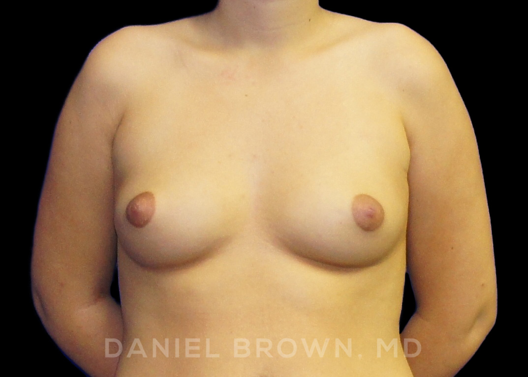 Breast Augmentation Patient Photo - Case 2417 - before view-
