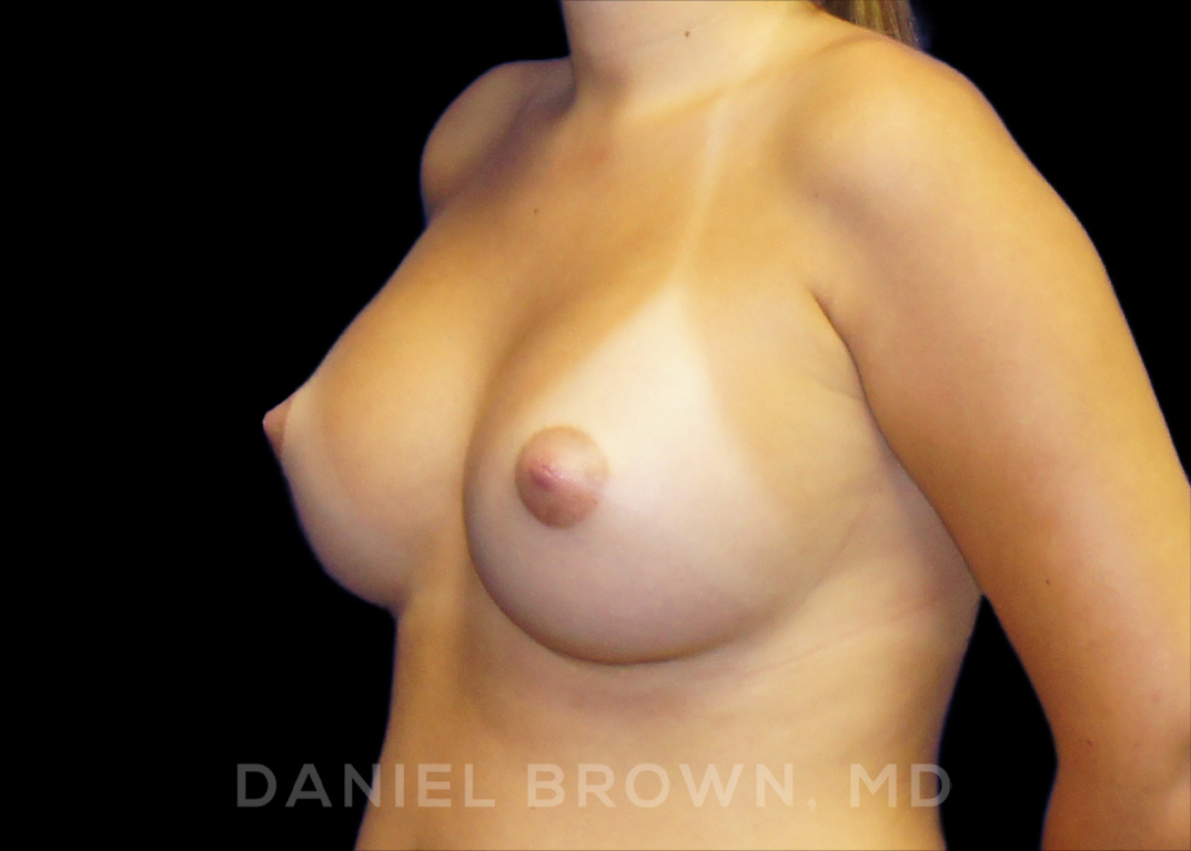 Breast Augmentation Patient Photo - Case 2417 - after view-1