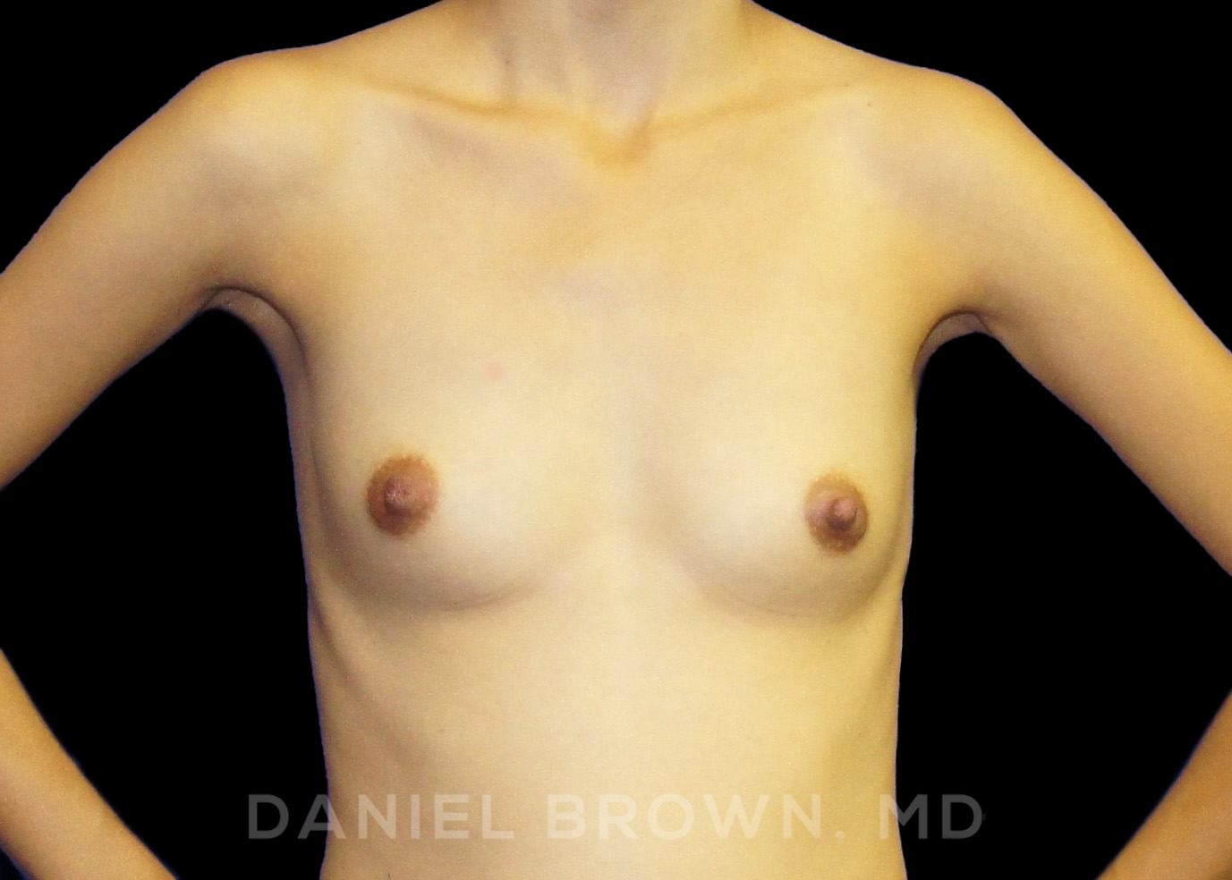 Breast Augmentation Patient Photo - Case 2424 - before view-