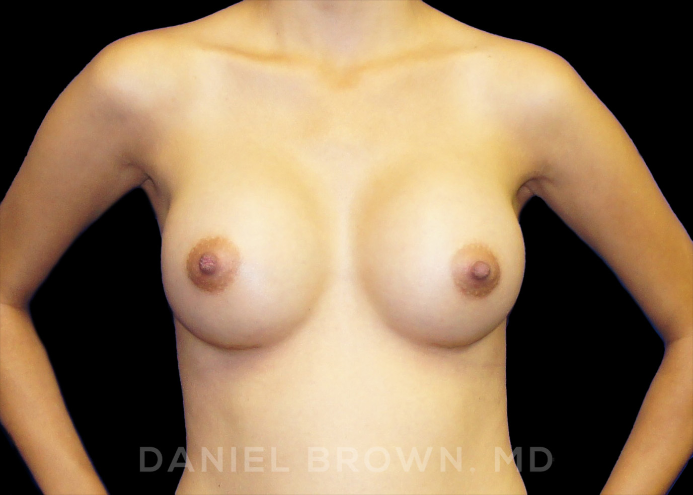 Breast Augmentation Patient Photo - Case 2424 - after view-0
