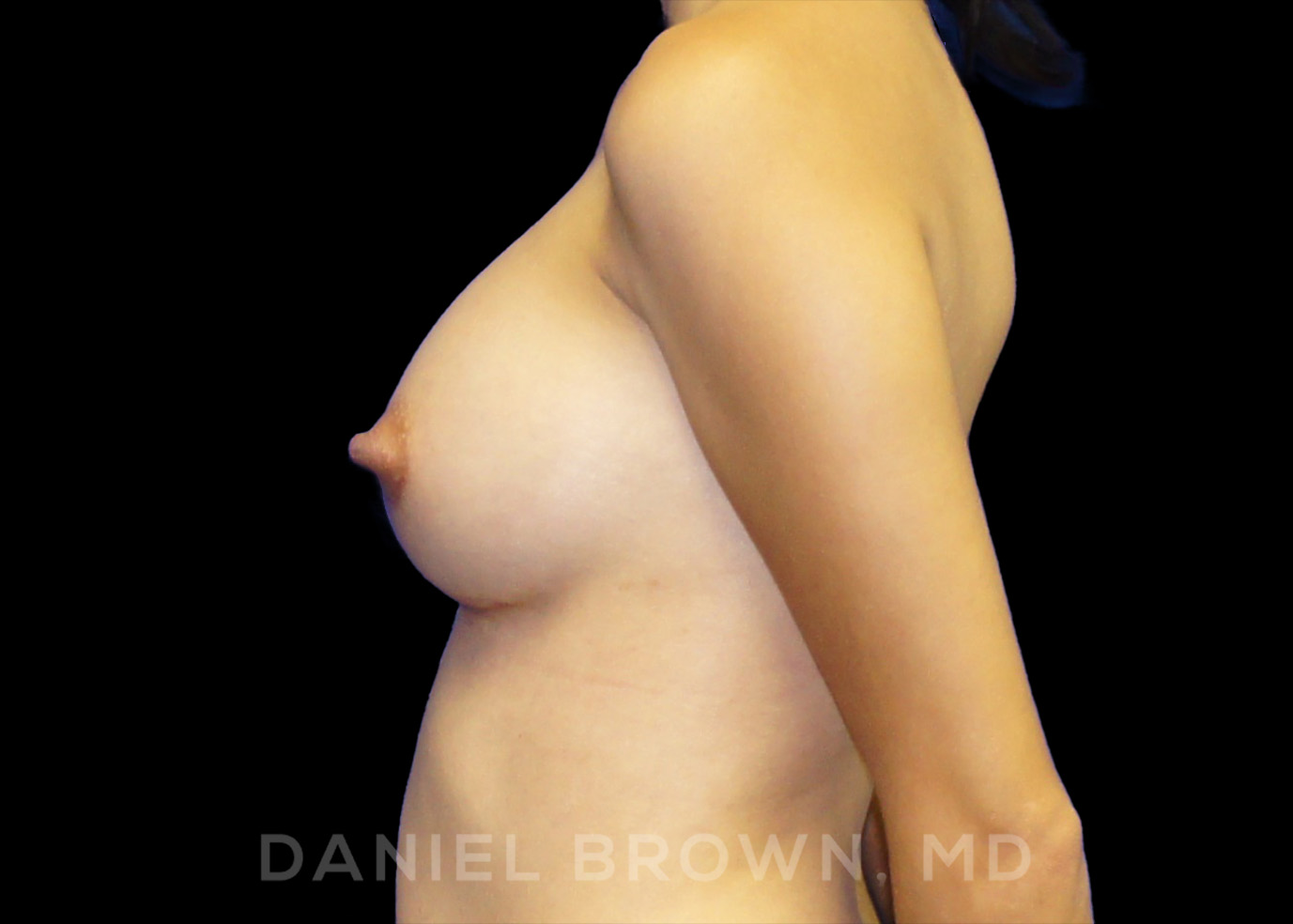Breast Augmentation Patient Photo - Case 2424 - after view-2