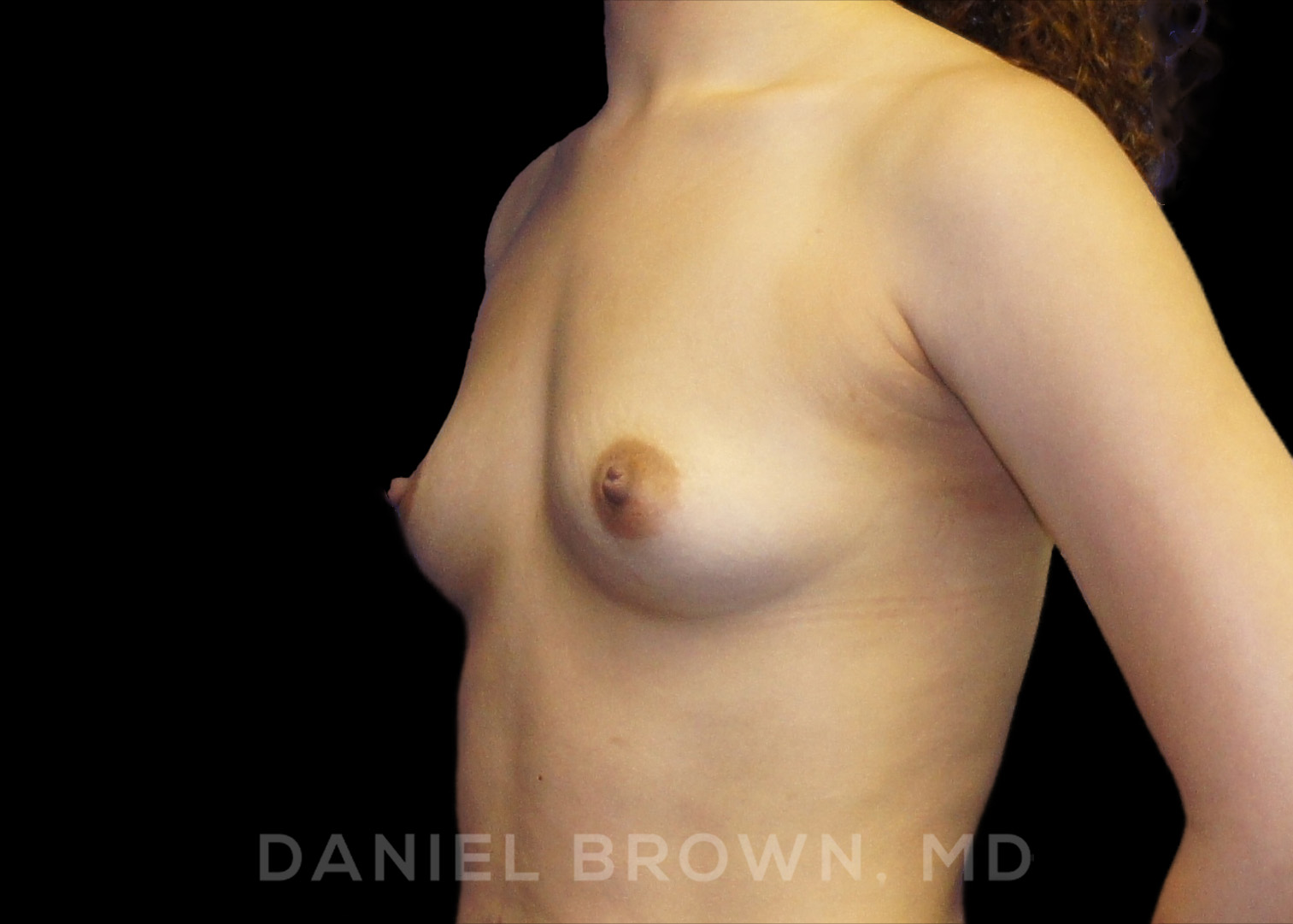 Breast Augmentation Patient Photo - Case 2431 - before view-1