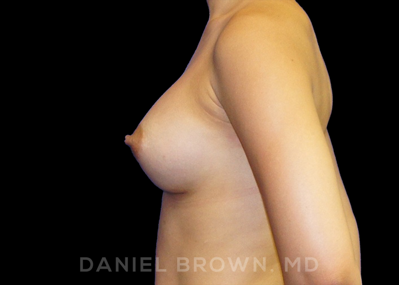 Breast Augmentation Patient Photo - Case 2431 - after view