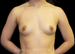 Breast Augmentation - Case 2431 - Before