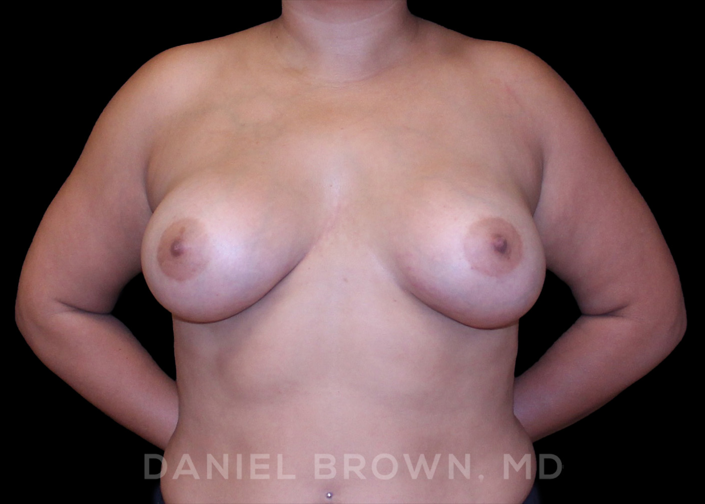 Breast Augmentation Patient Photo - Case 2438 - after view-0