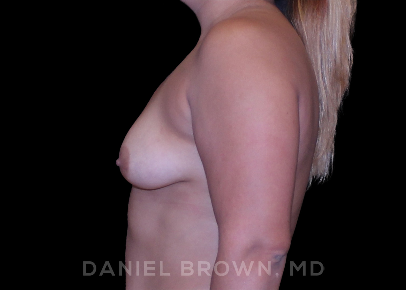 Breast Augmentation Patient Photo - Case 2438 - before view-