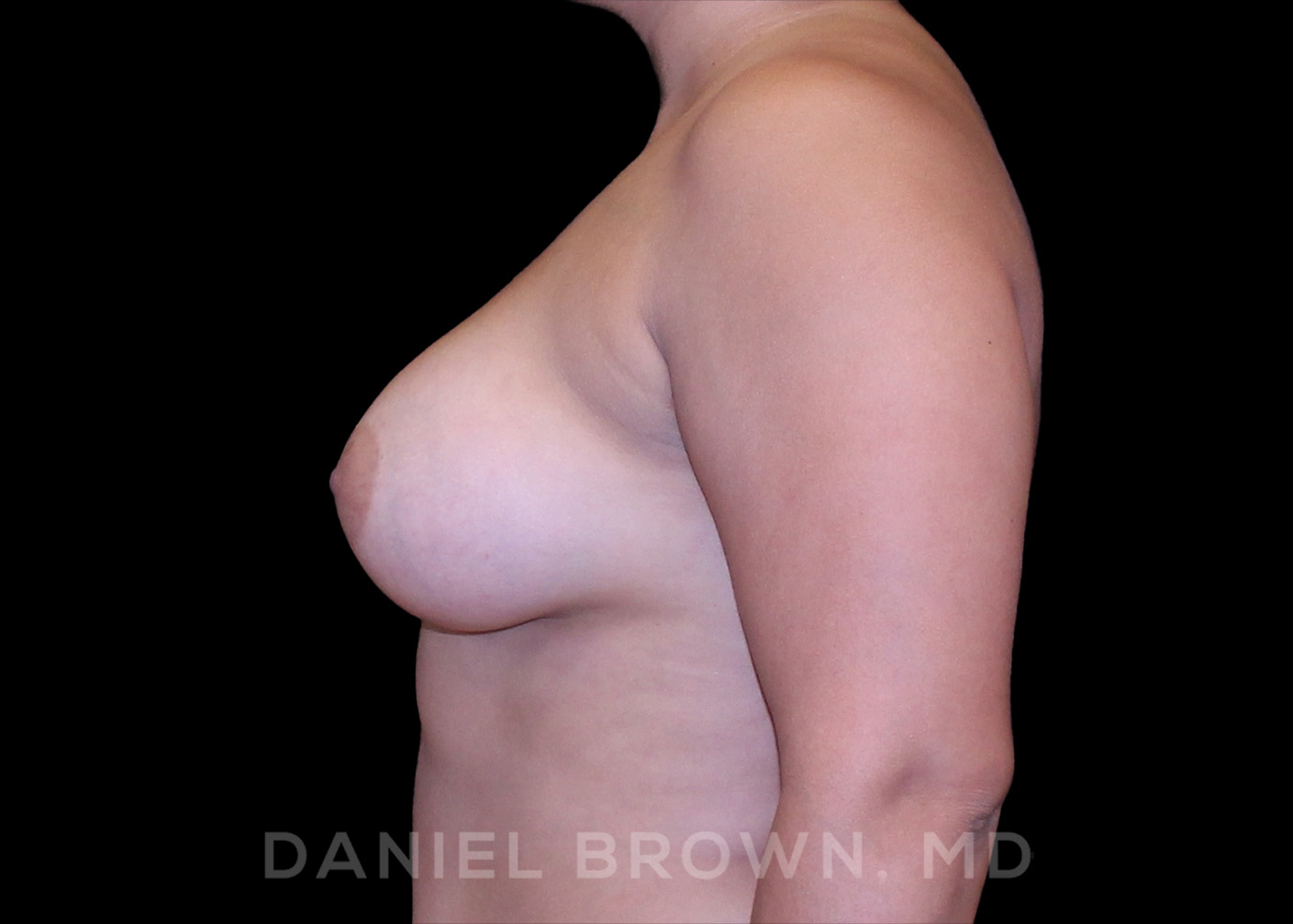 Breast Augmentation Patient Photo - Case 2438 - after view-2
