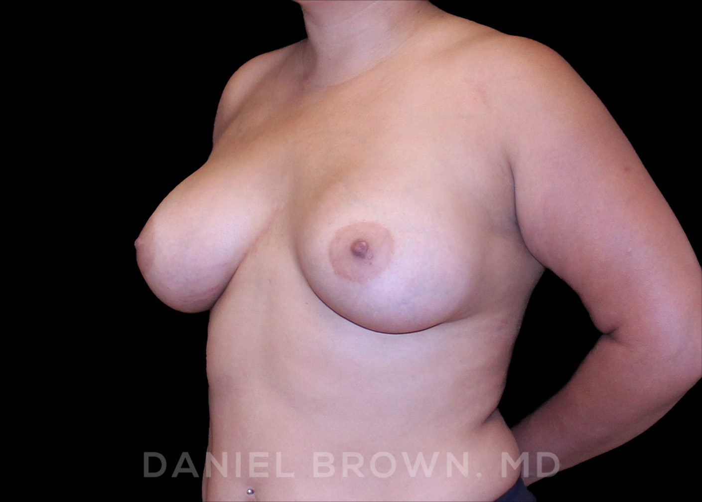 Breast Augmentation Patient Photo - Case 2438 - after view