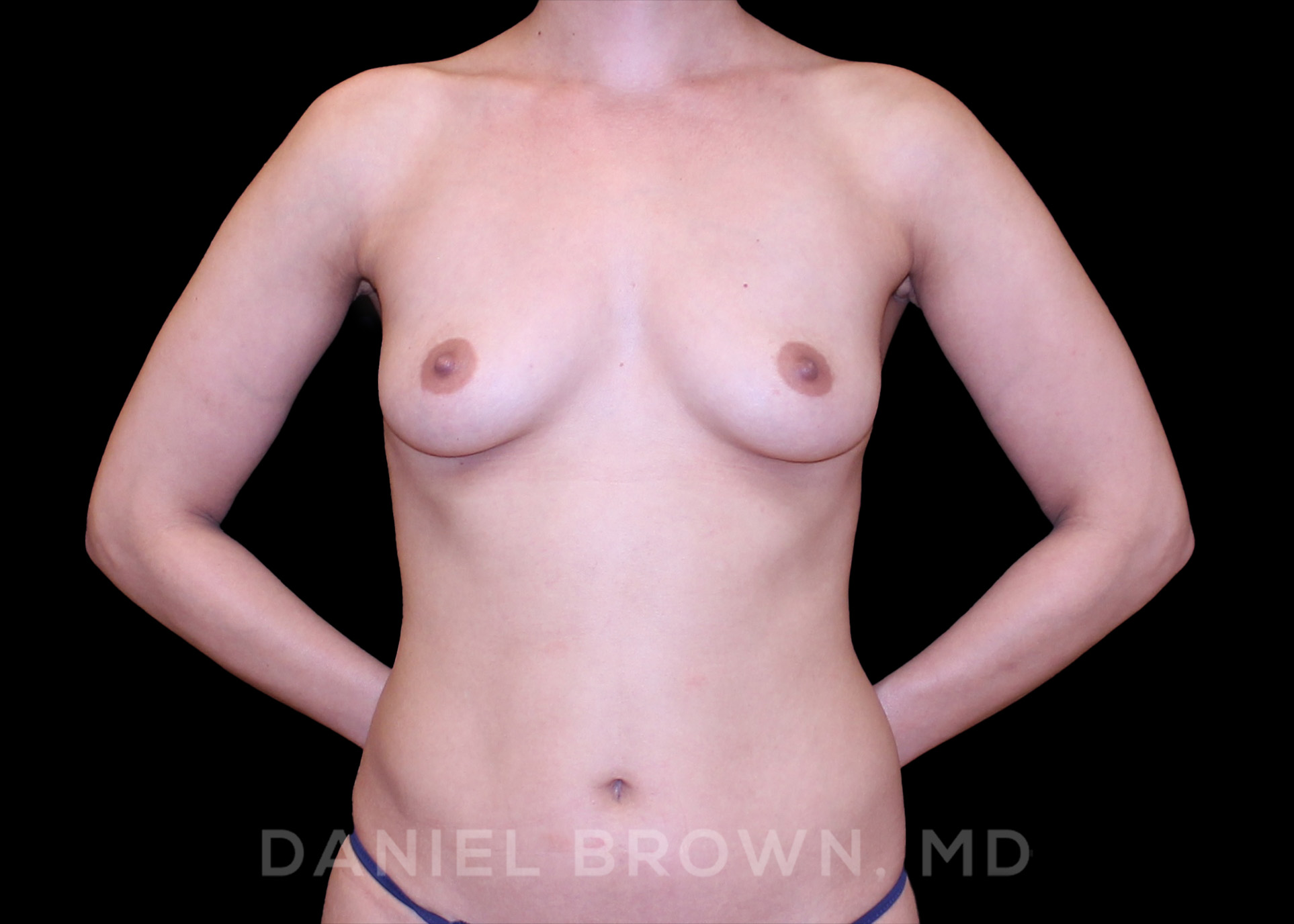 Breast Augmentation Patient Photo - Case 2445 - before view-