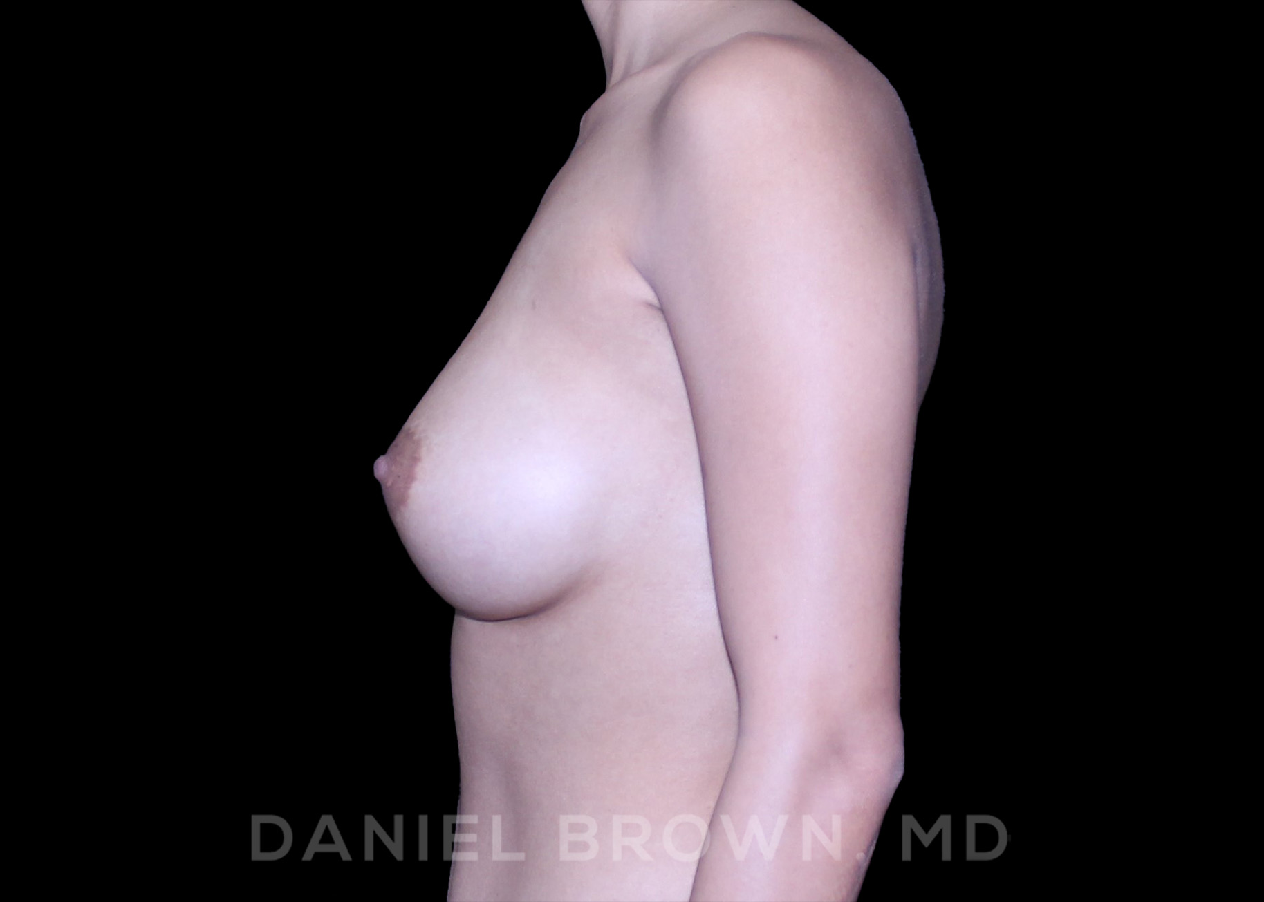 Breast Augmentation Patient Photo - Case 2456 - after view-3