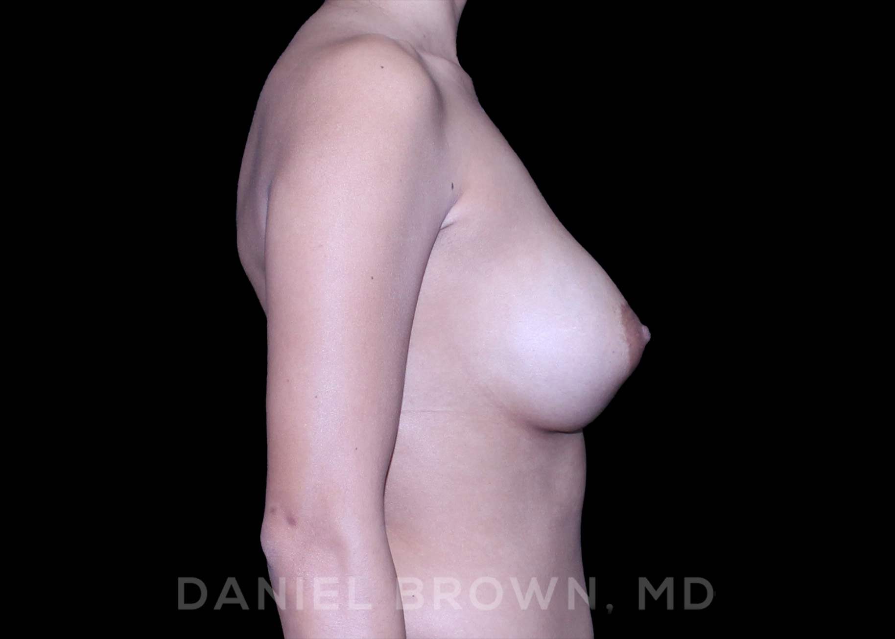Breast Augmentation Patient Photo - Case 2456 - after view-4