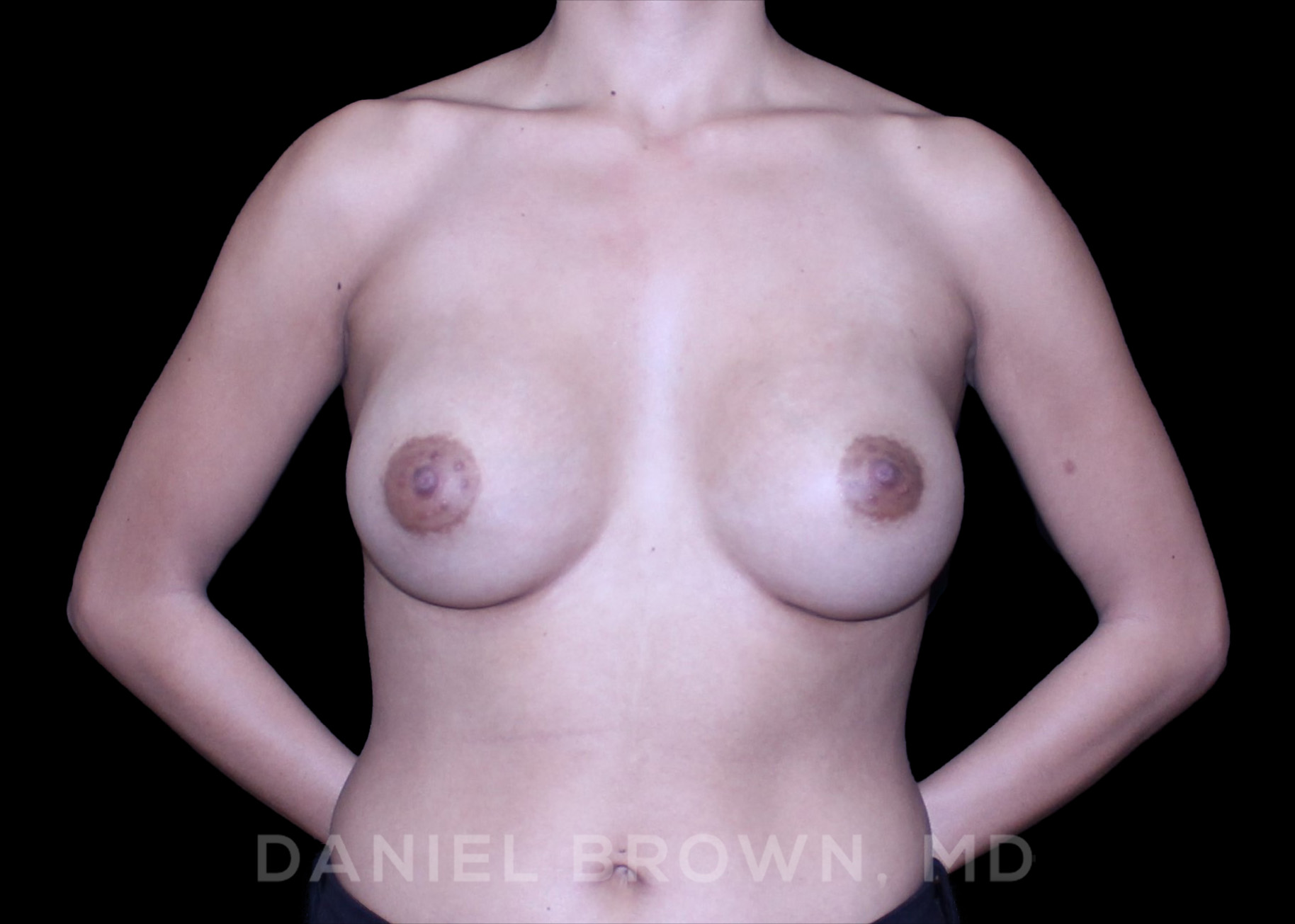 Breast Augmentation Patient Photo - Case 2456 - after view