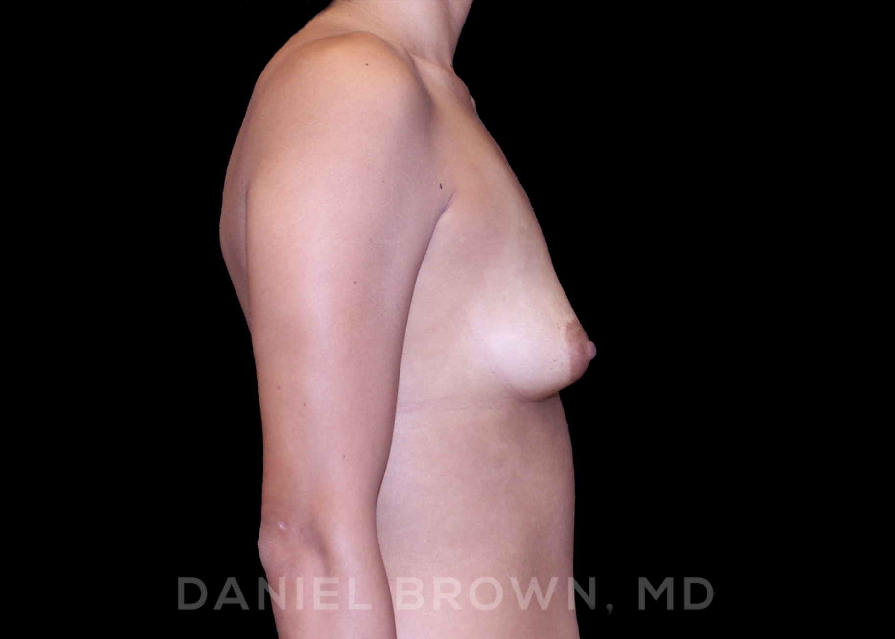 Breast Augmentation Patient Photo - Case 2456 - before view-4