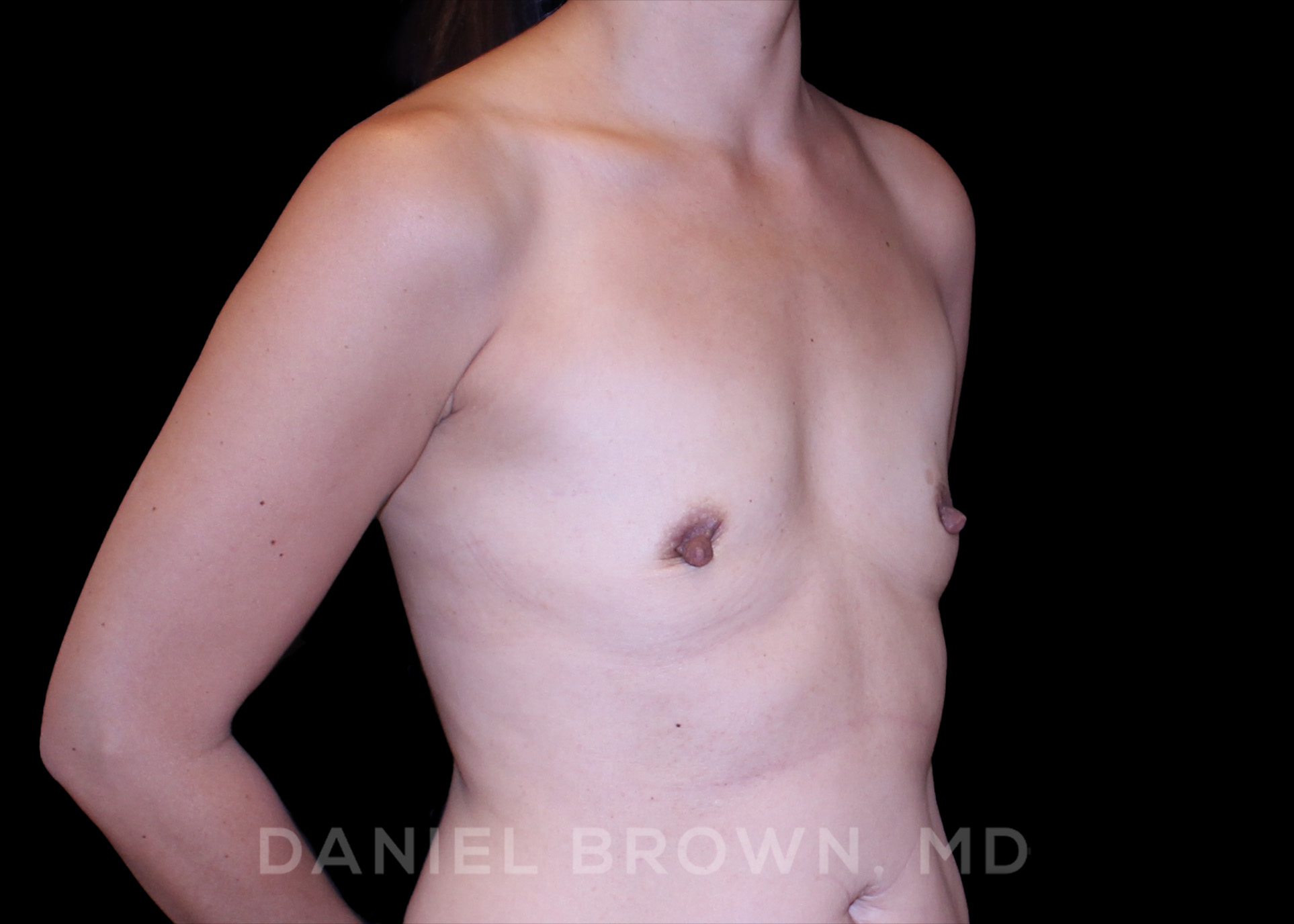 Breast Augmentation Patient Photo - Case 2467 - before view-