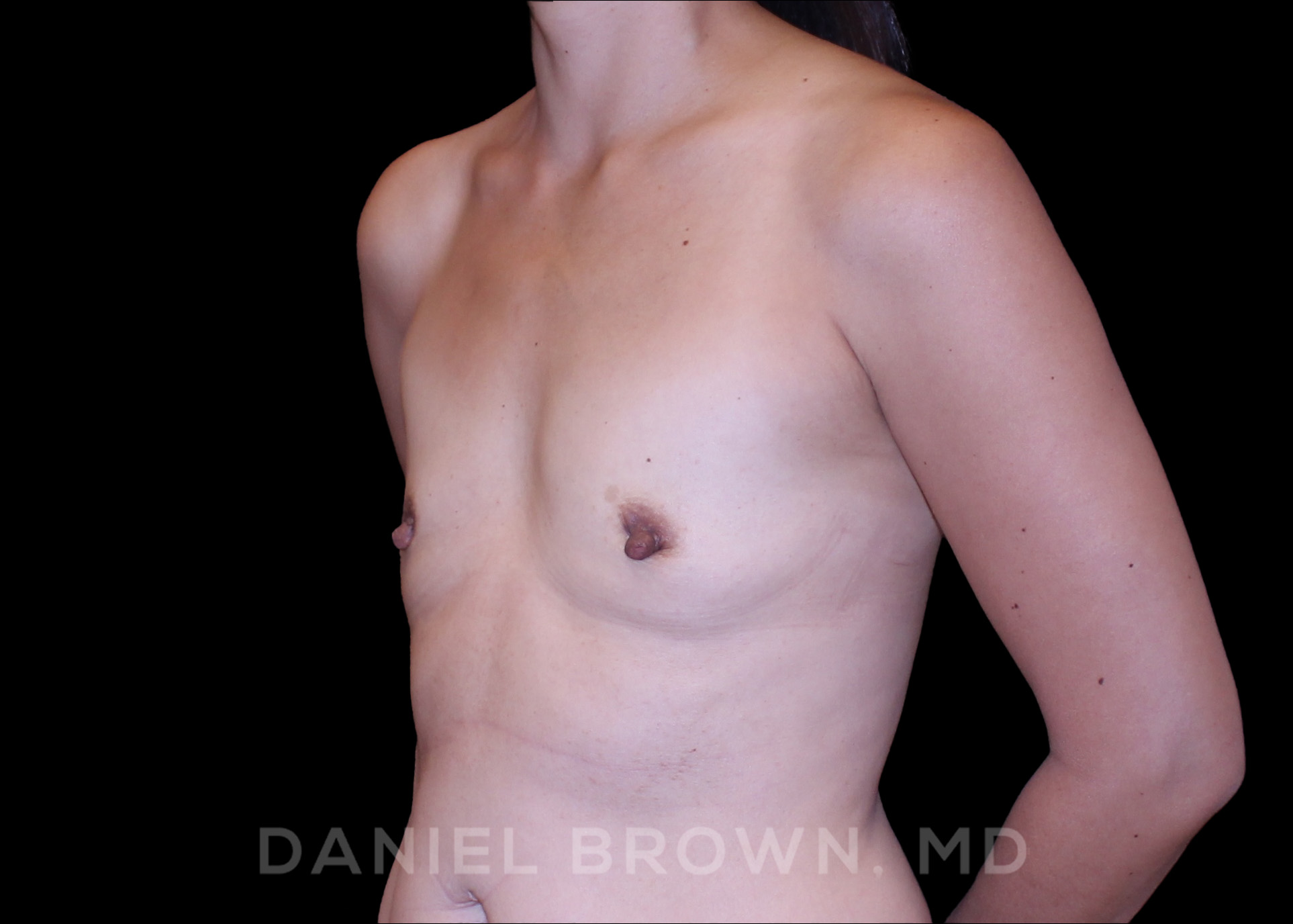 Breast Augmentation Patient Photo - Case 2467 - before view-