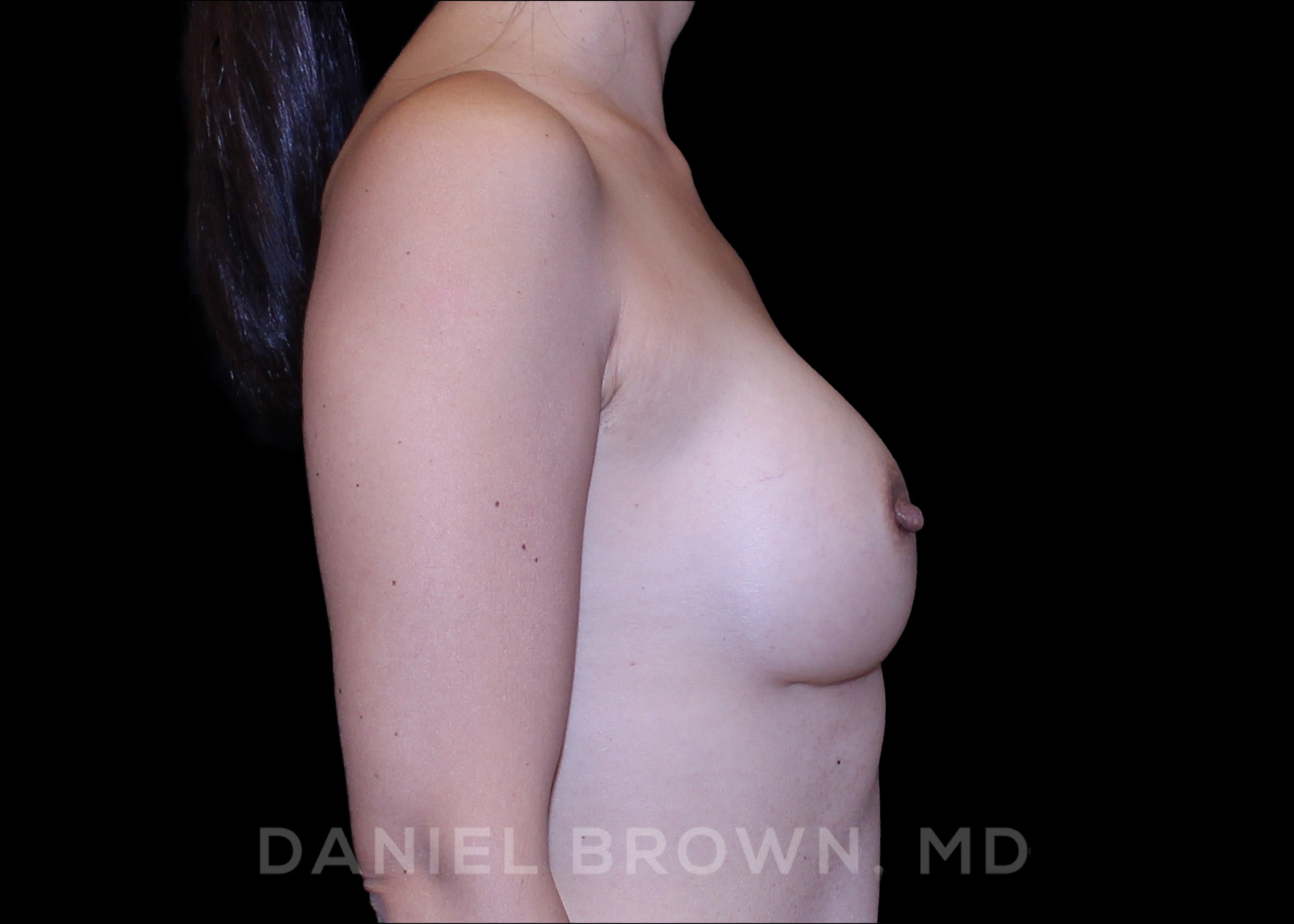 Breast Augmentation Patient Photo - Case 2467 - after view-4