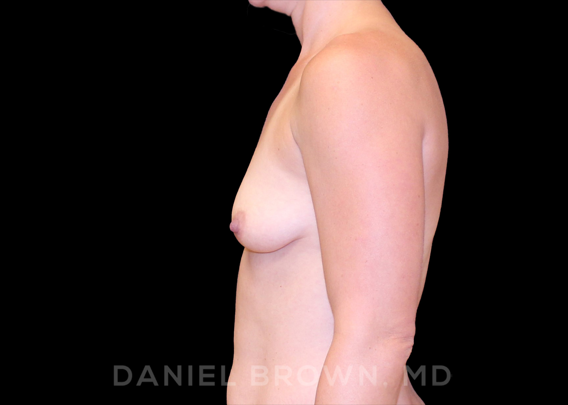 Breast Augmentation Patient Photo - Case 2478 - before view-3